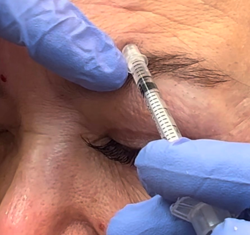 Botox