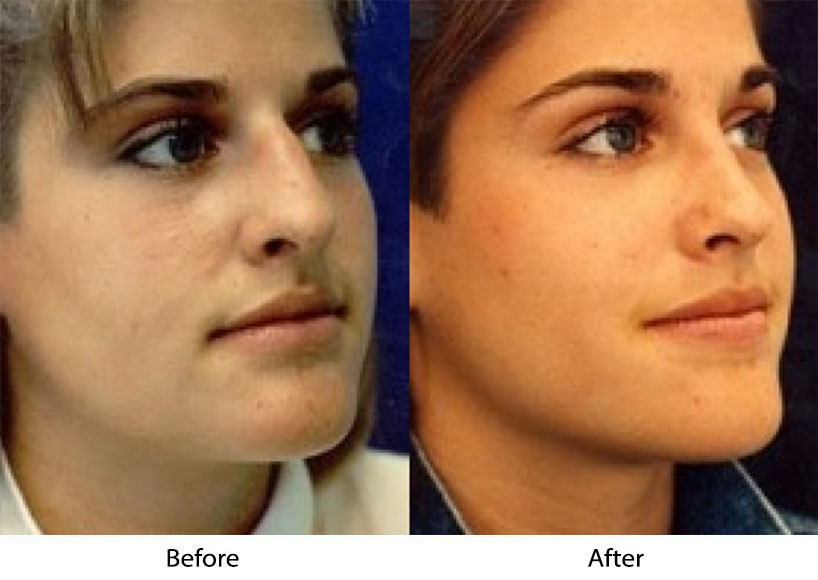 Scarless rhinoplasty in Los Altos & San Jose CA for subtle changes