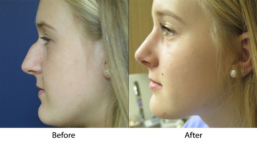 Scarless rhinoplasty in Los Altos and San Jose CA with expert tip precision