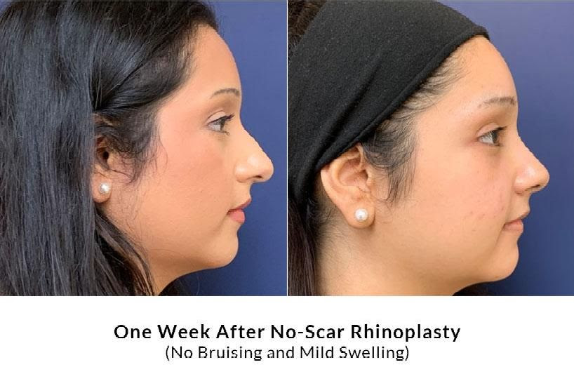 Scarless rhinoplasty in Los Altos and San Jose CA for subtle refinements