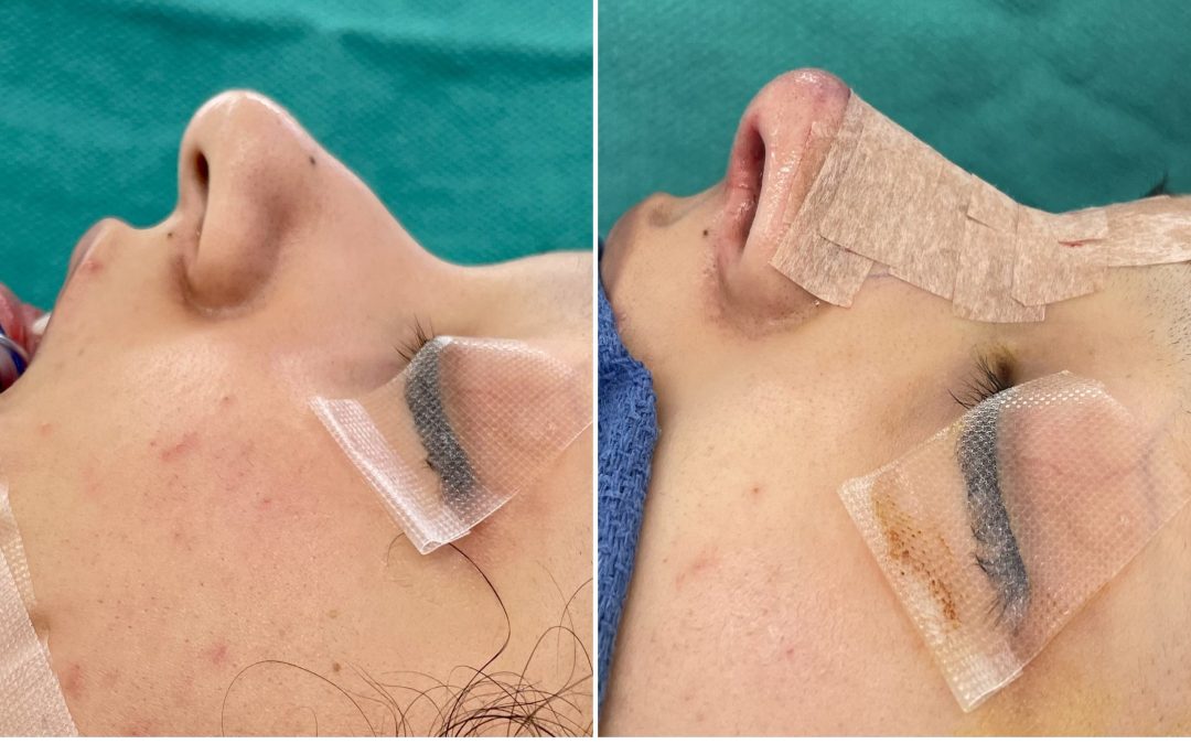 Scarless rhinoplasty in Los Altos & San Jose CA can enhance recovery